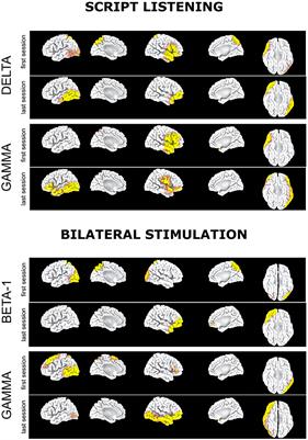 Metabolic and Electrophysiological Changes Associated to Clinical Improvement in Two Severely Traumatized Subjects Treated With EMDR—A Pilot Study